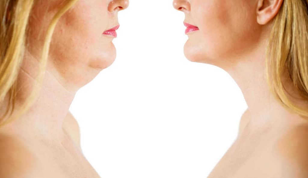 Double Chin treatment Custom House before and after results