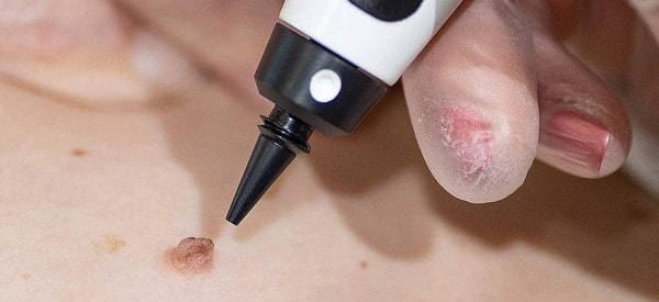 After Skin Tag Removal Custom House