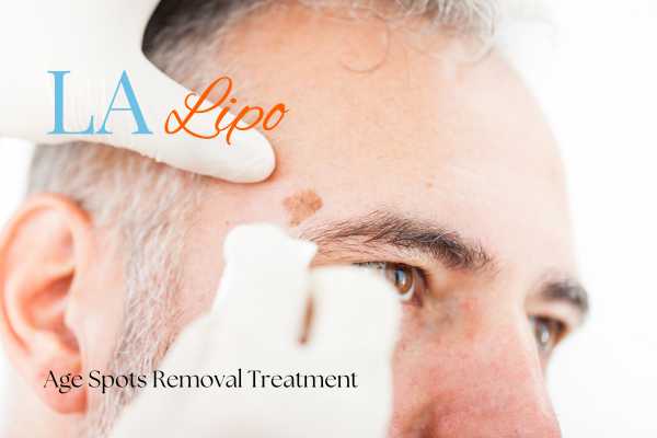 What Are the Most Effective Treatments for Age Spots Custom House?
