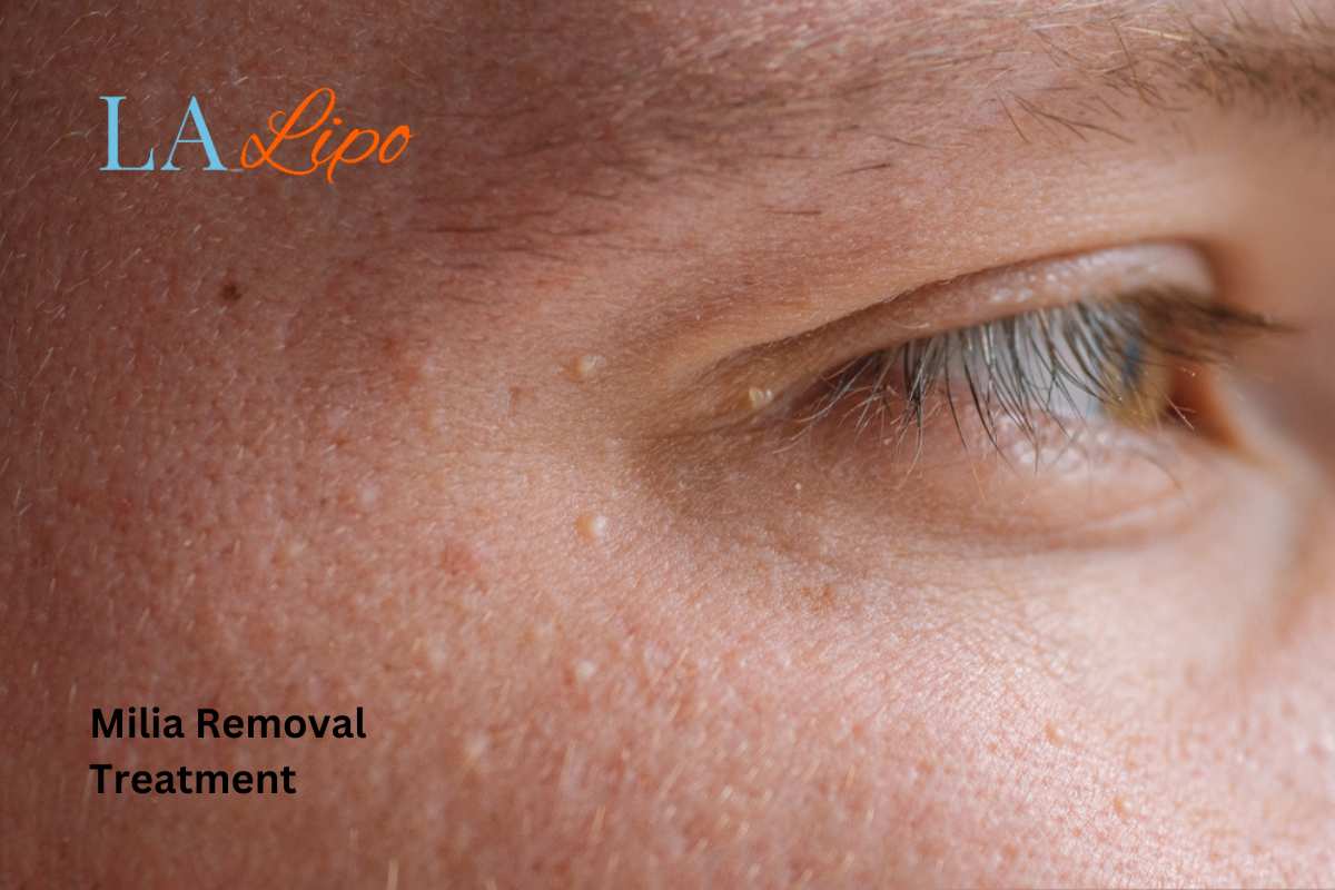 Cryopen Milia Removal: Is It the Easiest and Safest Option Custom House?