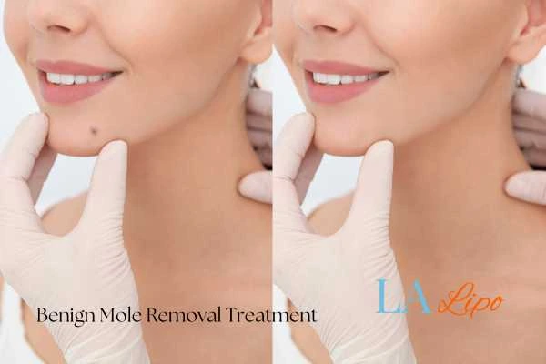 woman's before and after mole removal Custom House results