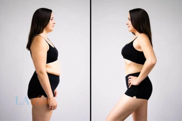 image of woman before and after results of LA-EMS Body Sculpting Custom House to help treat Diastasis recti