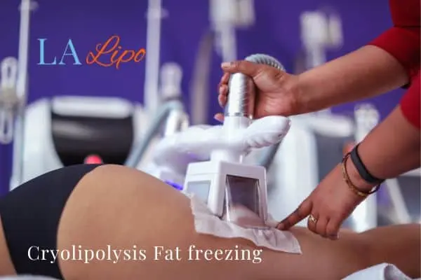 women getting fat freezing Custom House