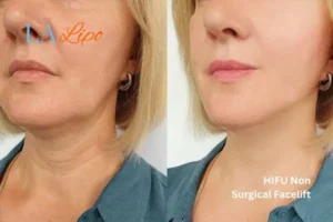 hi-fu for wrinkles Custom House before and after results