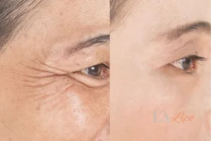 Before and after results of woman - HI-fu wrinkles reduction treatment Custom House