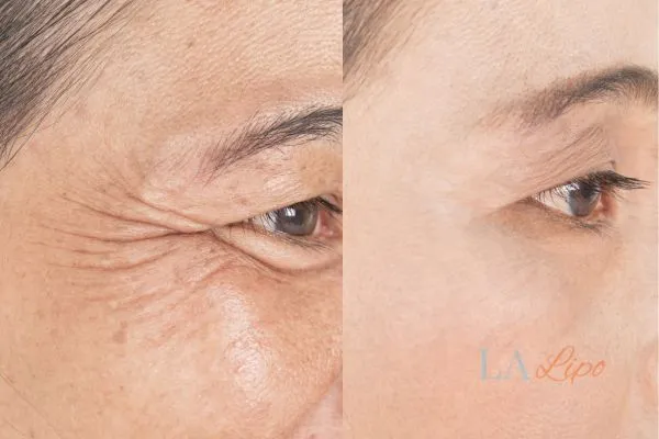 Before and after results of woman - HI-fu wrinkles reduction treatment Custom House