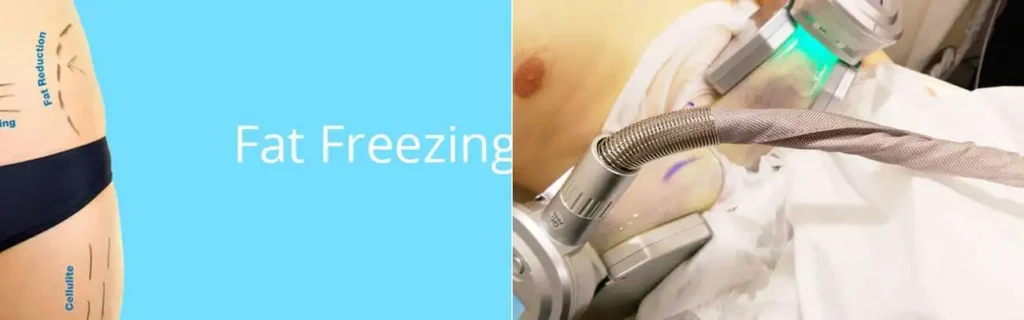 Fat freezing Custom House on multiple areas of the body