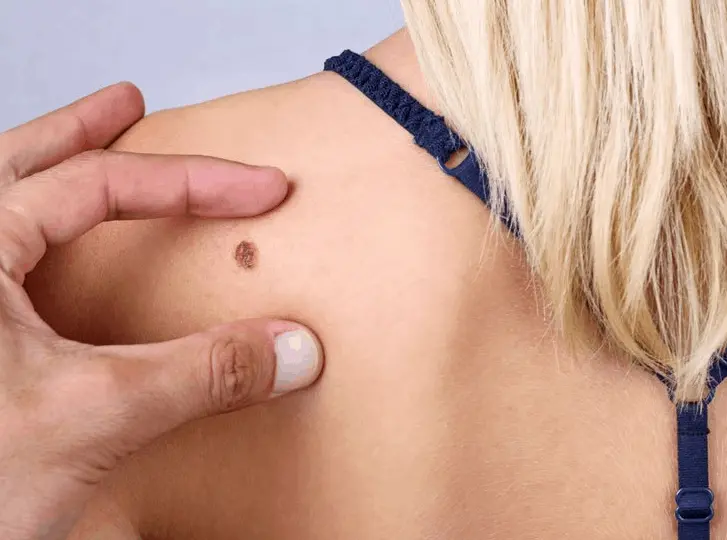 woman having mole removal Custom House consultation before treatment.