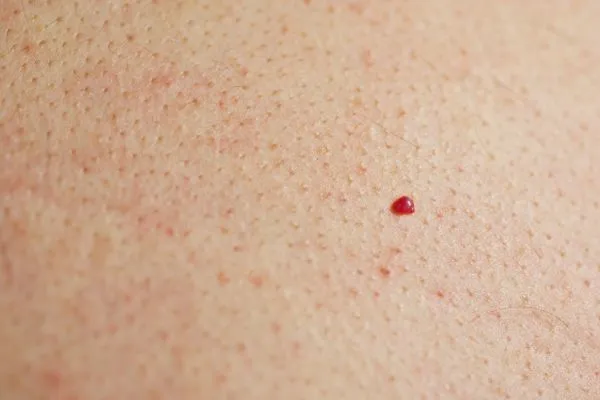 close up of a cherry angioma Custom House
