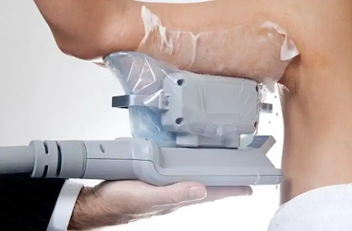 Picture of fat freezing Custom House on the upper arms.