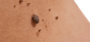 image of a skin tag Custom House