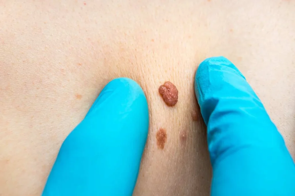 Consultant examining a skin tag Custom House