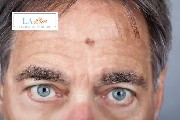 Solar Lentigo Removal Custom House image of man with mark on his forehead