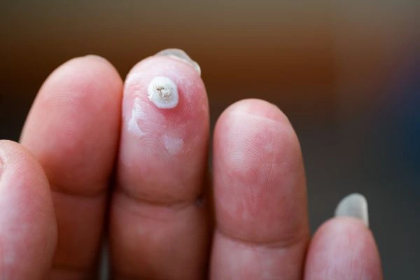 wart on person finger - cryotherapy to treat from LA LIPO Custom House
