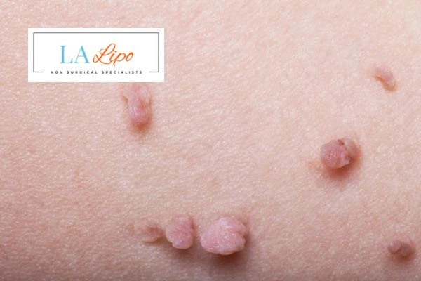 Does cryopen skin tag removal Custom House hurt? Find out now call our team today!