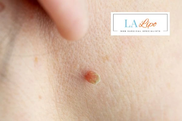 Book skin tag removal Custom House today speak to our team now!