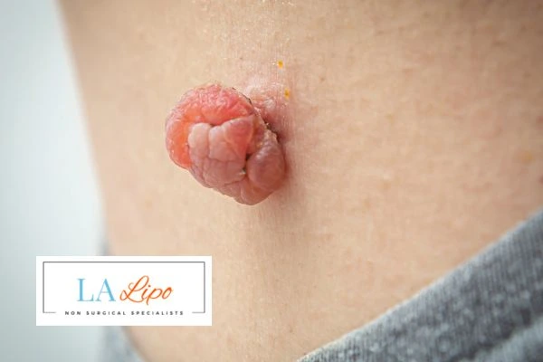 Interested in skin tag removal Custom House? Concerned about the pain? Find out more today!