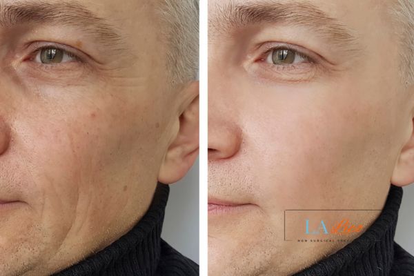 See the amazing results of Morpheus8 Treatment Custom House!