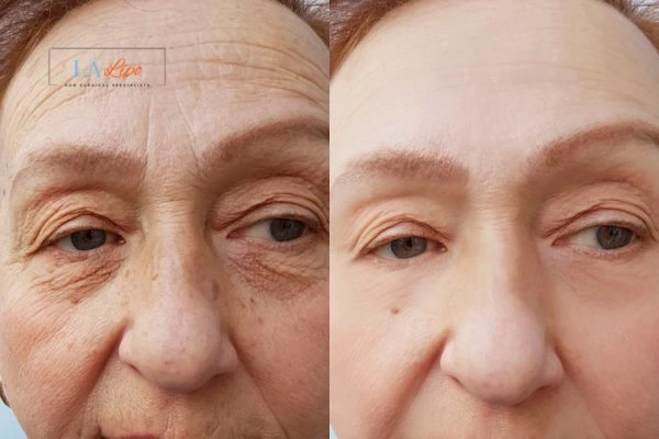 The powerful benefits of Morpheus8 Treatment Custom House - Call Our team today!
