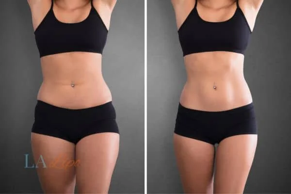 before and after results of non-surgical treatment to help a woman's body image and mental health Custom House