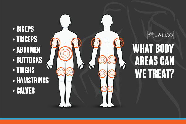 Diagram to show areas you can have LA-EMS Body Sculpting Treatment Custom House