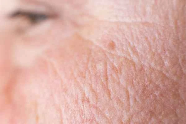 close up picture of a woman's face showing an age spot Custom House