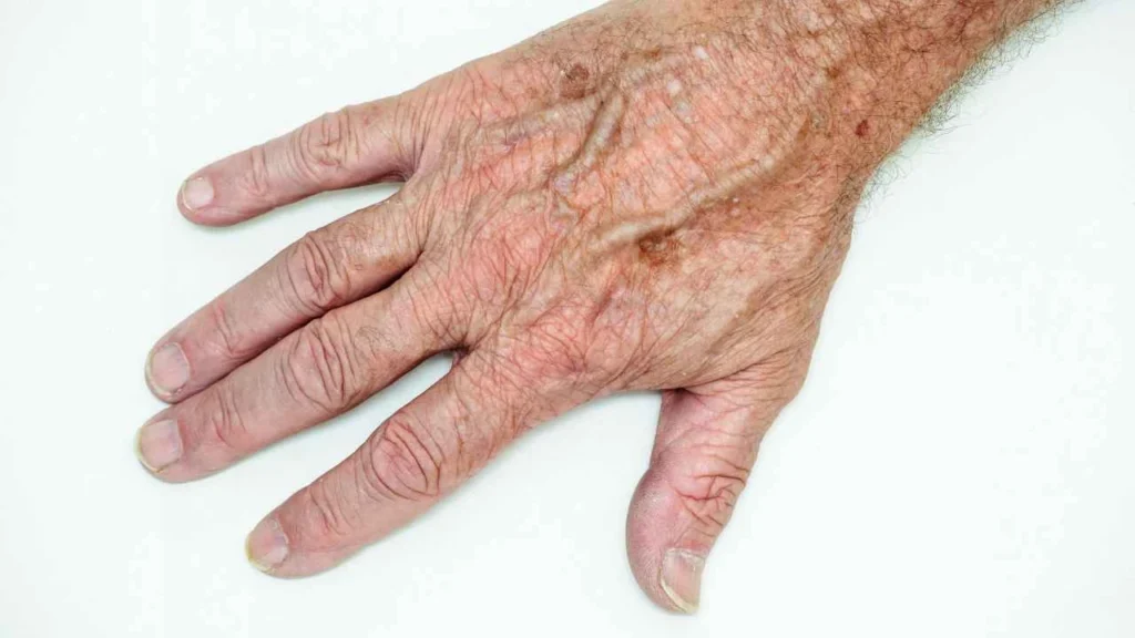 Male hand showing age spot Custom House