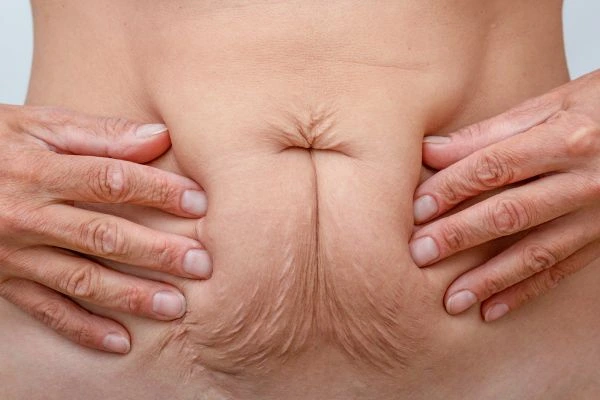 Image of a woman's stomach with loose skin - example of skin tightening Custom House options