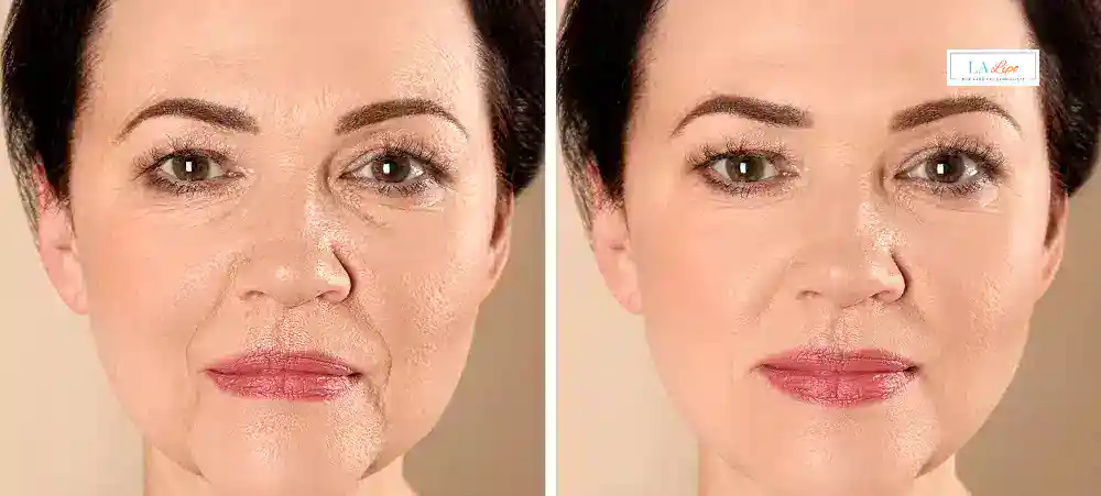 How Long Does It Take to See Results and How Long Do They Last Custom House?