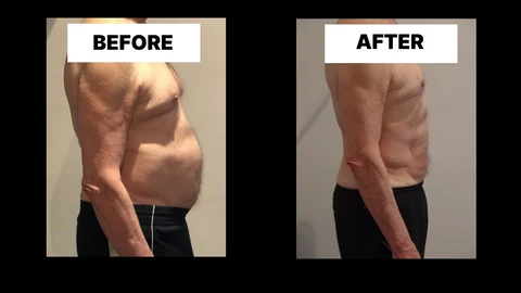 What Symptoms Can Diastasis Recti Cause in Men? Weak Core, Back Pain and Poor Posture Custom House